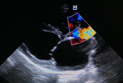 TRiCares Initiates EU Pivotal Study For Topaz Tricuspid Valve Replacement