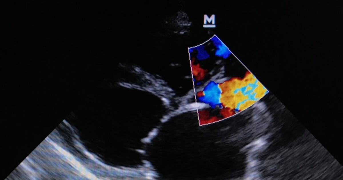 Topaz Study TRiCares Initiates EU Pivotal Study For Topaz Tricuspid Valve Replacement
