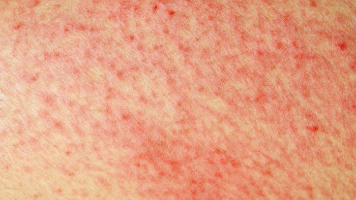 Shingrix Outbreak Rash GSK Shingrix Shingles Vaccine Seen Displacing Zostavax After US FDA ...