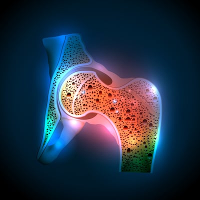 Osteoporosis Drug Development Boosted By New Bone Mineral Density Surrogate Endpoint 