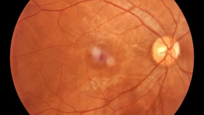 Eyeing Early Chronic Disease Detection Through AI-Based Retinal Scans