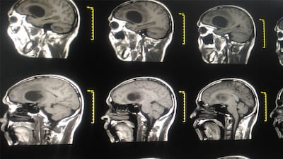 Glioblastoma Market Snapshot: Two Approvals In 2024 And A Rich Pipeline