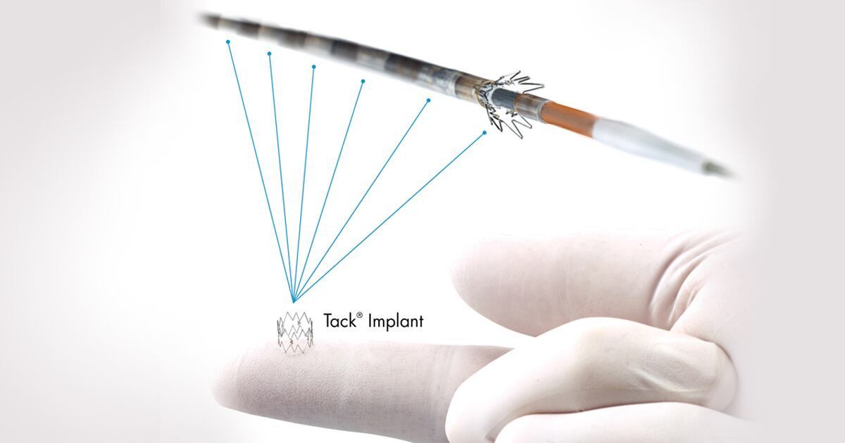 Intact Vascular’s Tack Peripheral Dissection Repair Device Earns PMA
