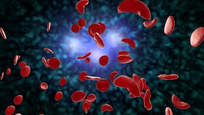 Medicaid Payment Model For Sickle Cell Gene Therapy May Have Limited Impact Until 2026