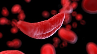 Vertex Resolves To Reverse English Funding Rejection For CRISPR Sickle Cell Gene Therapy