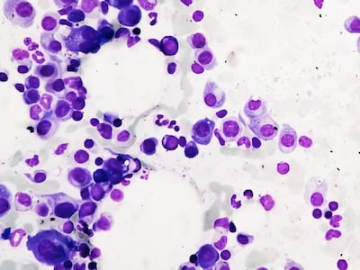 US FDA Finally Backs Minimal Residual Disease Endpoint For Accelerated Approval In Myeloma