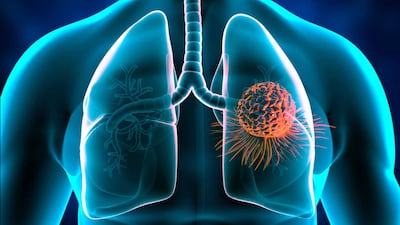 ASCO: Ivonescimab A New Challenger To Keytruda In 1L, PD-L1-High NSCLC?