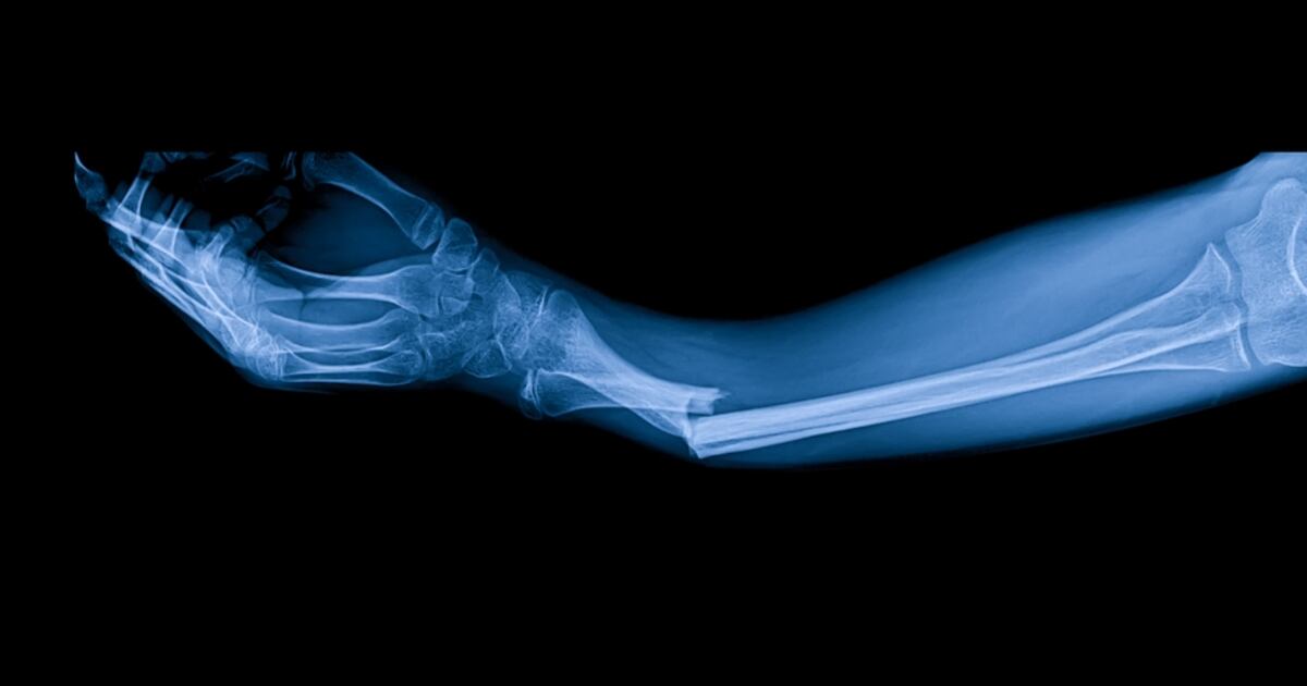 Setrusumab Ultragenyx And Mereo’s Hopes Fracture As Setrusumab Fails Phase III Trials