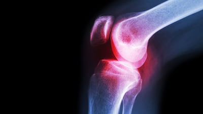 Bone Has Tough Path Forward After Phase III Knee Osteoarthritis Fail