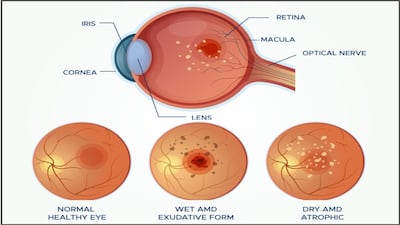 Adding B Vitamins To AREDS Has Bausch + Lomb Seeing Consumer Health Sales Boost Ahead