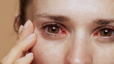 Dry Eye Crossover Study Could Allow Aldeyra A Quick Response To US FDA’s CRL For Reproxalap